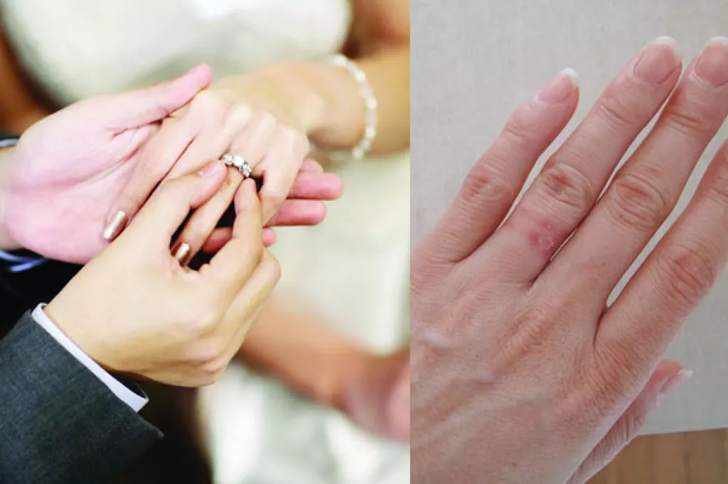 Everything You Must Know About Engagement Or Wedding Ring Allergy