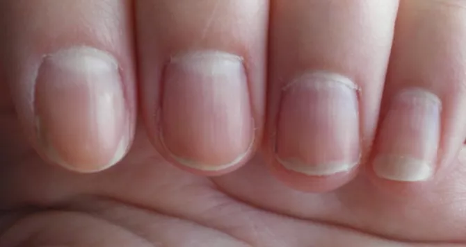 Darkening of the nail bed due to vitamin deficiency - wide 5