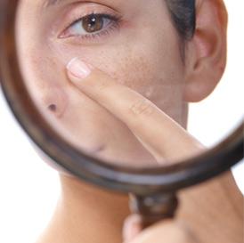 5 Best Homemade Face Masks for Acne