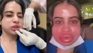 Uorfi Javed Looks Unrecognisable As She Dissolves Lip Fillers, Face Swelled Up 'Buri Halat Ho Gayi'
