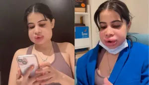 Uorfi Javed Shows Off Swollen Faces Days After Dissolving Lip Fillers, Netizen Say 'Mujhe Dard..'