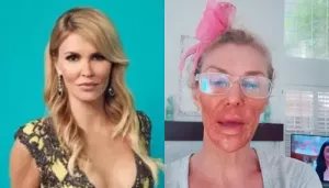 Brandi Glanville Suffers Chemical Burns, Was Trying To Kill Parasites With DIY Hack, 'Burned The..'