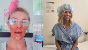 After Getting Burns From DIY Hack, Brandi Glanville Starts Treatment For Facial Damage, 'A Lot Of..'