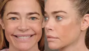 Denise Richards Looks Unrecognisable, Shares Shocking Before And After Photos After Facelift
