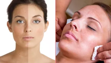 Everything You Should Know About Freckles And The Ways To Treat Them