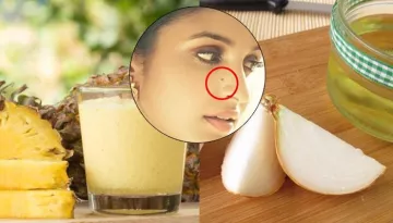 Best Home Remedies To Remove Moles Naturally From Face Without Any Surgery