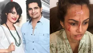 Nisha Rawal Reveals Karan Mehra Grabbed Her Hair And Pushed Her On A Wall, Shows Off Her Head Injury