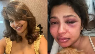 Malayalam Actress Anicka Vikhraman Accuses Ex-BF Of Brutally Beating Her, Shares Pictures Of Bruises