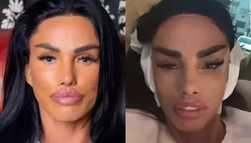 Katie Price Reveals Plastic Surgery Scars After Accidentally Ripping Off Fox Eye Lift Stitches