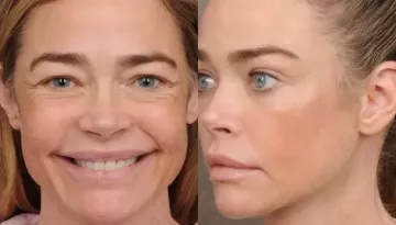 Denise Richards Looks Unrecognisable, Shares Shocking Before And After Photos After Facelift