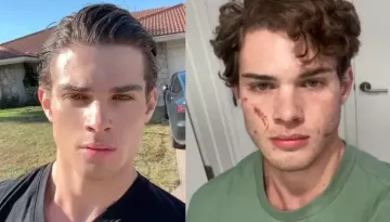 'Looksmaxxing' 20-Yr-Old Influencer, Clavicular Speaks After Hospitalisation Due To Overdose