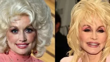 Dolly Parton Once Confessed To Undergoing Plastic Surgery, Her Before-And-After Pics Surface