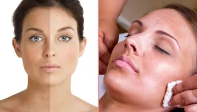 Everything You Should Know About Freckles And The Ways To Treat Them