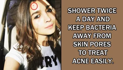 5 Amazing Tips That Can Help You Avoid Acne This Summer And Enjoy Clear And Healthy Skin