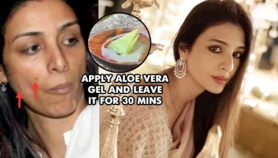  Home Remedies To Cure Dark Spots That Are Way More Effective Than Salon Treatments   