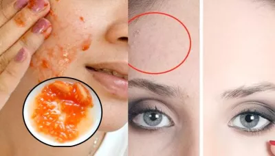 Homemade Remedies And Cosmetic Procedures To Easily Get Rid Of Open Pores