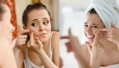  6 Body Parts That Are Prone To Acne And Lifestyle Hacks To Treat Acne Without Any Medication   