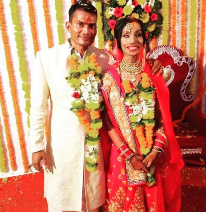 Acid attack survivors love stories