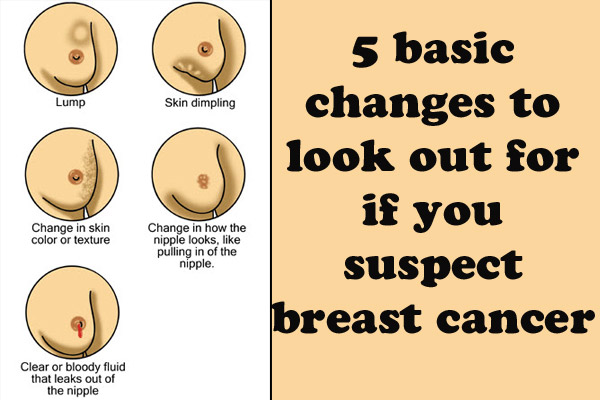 breast cancer symptoms 