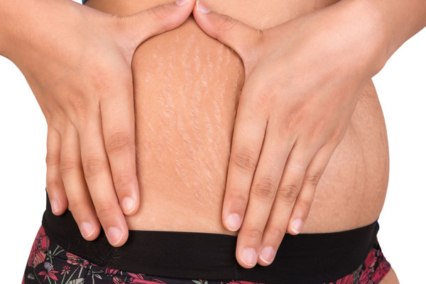 How to treat stretch marks