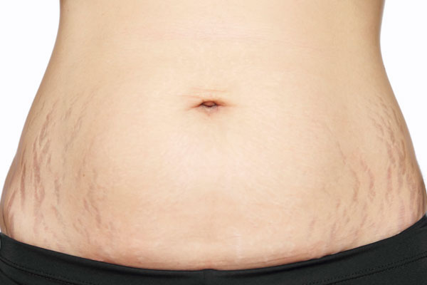 How to treat stretch marks