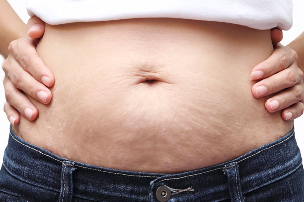 How to treat stretch marks