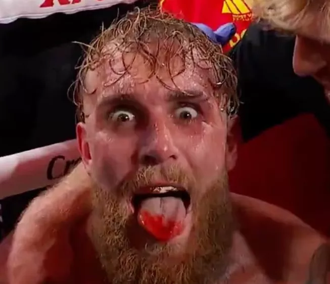 Jake-Paul-Broken-Jaw