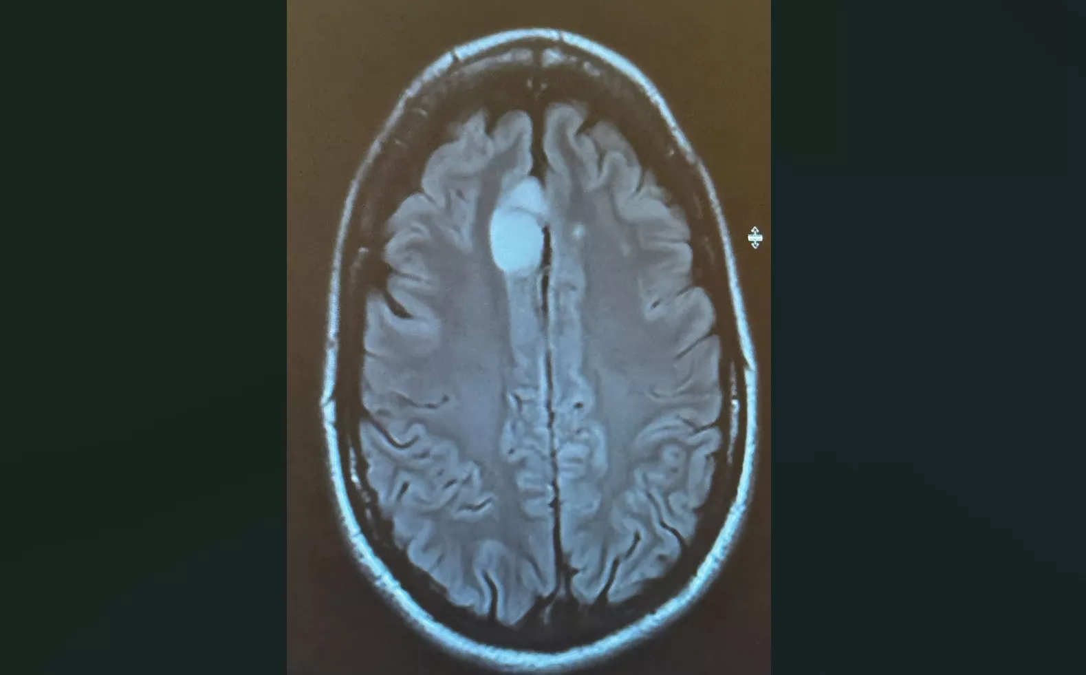 mri