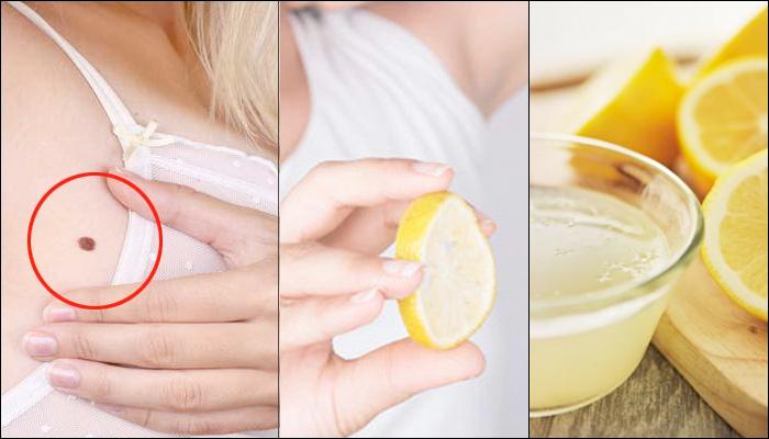 8 Easy Home Remedies For Quick Removal Of Skin Tags
