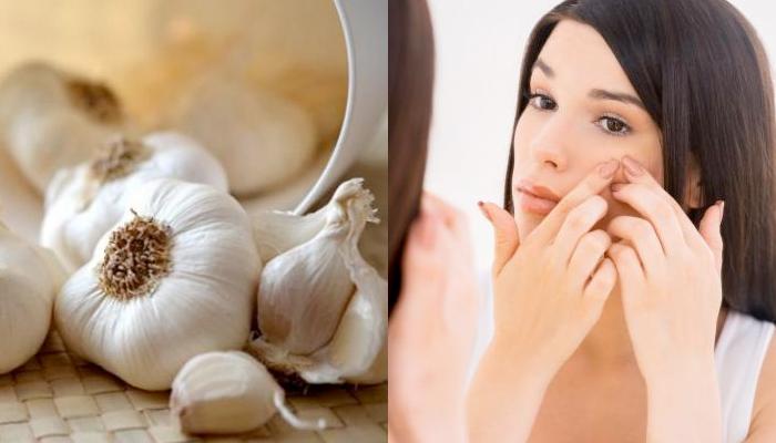 17 Unknown Beauty Benefits Of Garlic (Lahsun) For Hair, Skin And Health