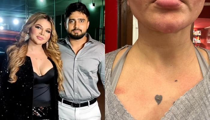 Rakhi Sawant Shows Bruises She Allegedly Got From Adil, Her Brother Gives Medical Record As Proof