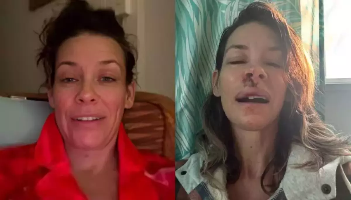 What Caused Evangeline Lilly's Traumatic Brain Damage After Hawaii Fall? 'I Smashed My...'
