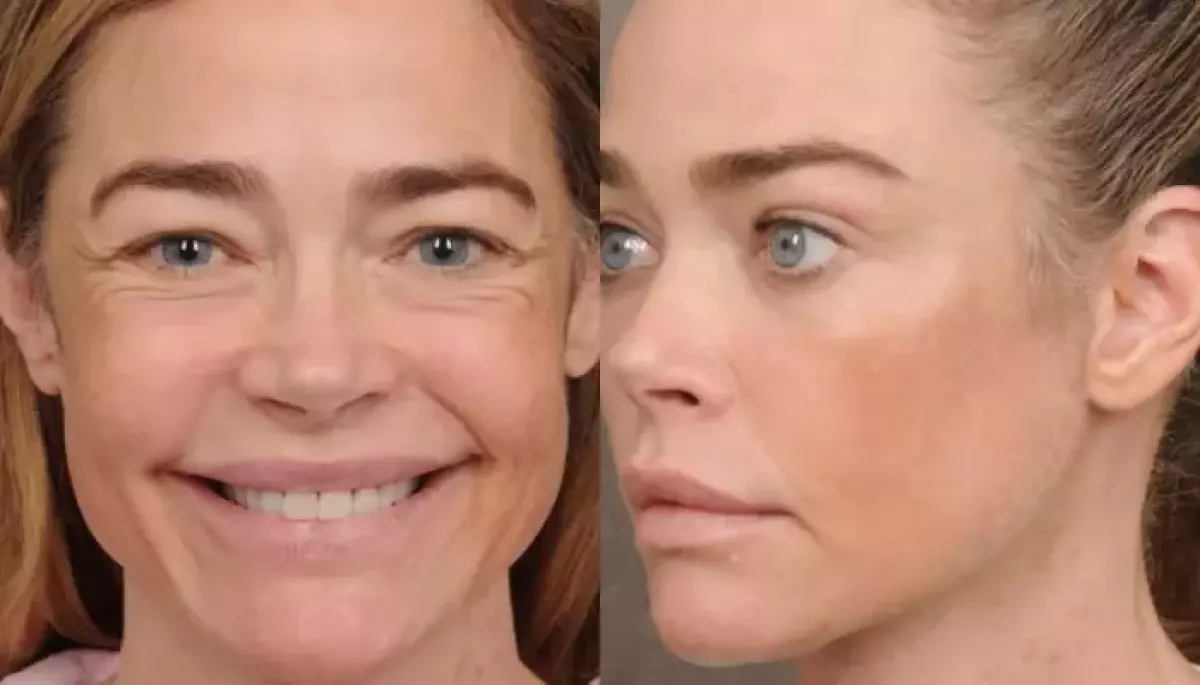 Denise Richards Looks Unrecognisable, Shares Shocking Before And After