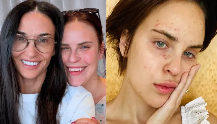 Demi Moore's Daughter Tallulah Willis' Before-And-After Face Filler Dissolving Pics Surface
