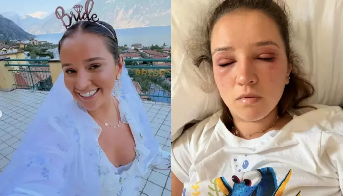 26-Year-Old Bride-To-Be 'Almost Left Blind' After USD 88 Eyelash Treatment Before Wedding